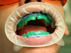 beleni-zubu-u-zubare-postup