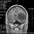 Magnetická rezonance mozku s nádorem