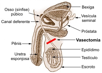 vazektomie_vasektomie_prubeh_operace_informace_velky.jpg